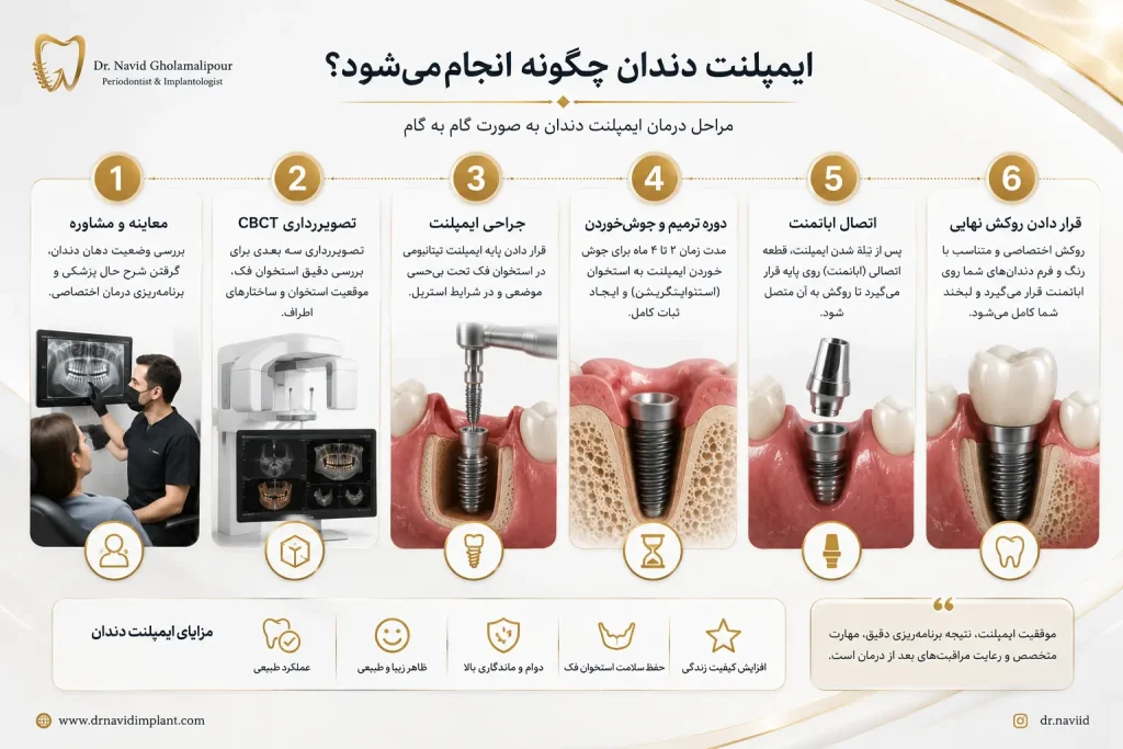 ایمپلنت-دندان-چگونه-انجام-میشود