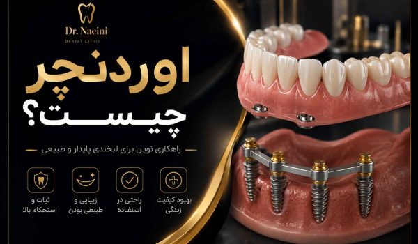 اوردنچر چیست