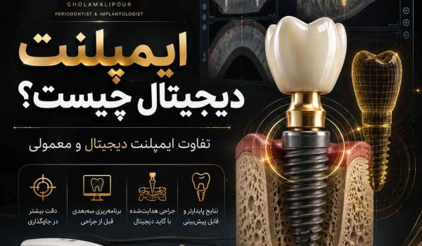 ایمپلنت دیجیتال