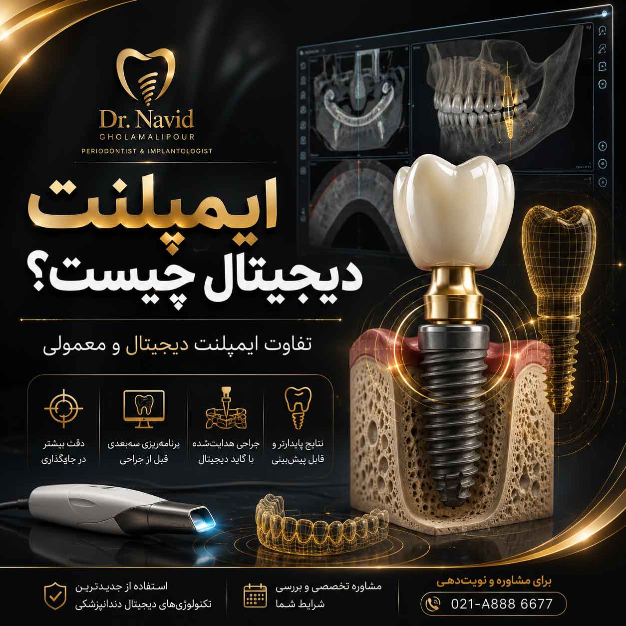 ایمپلنت دیجیتال