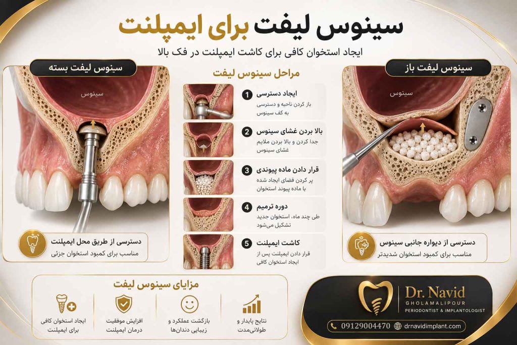 انواع سینوس لیفت