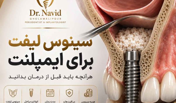 سینوس لیفت برای ایمپلنت