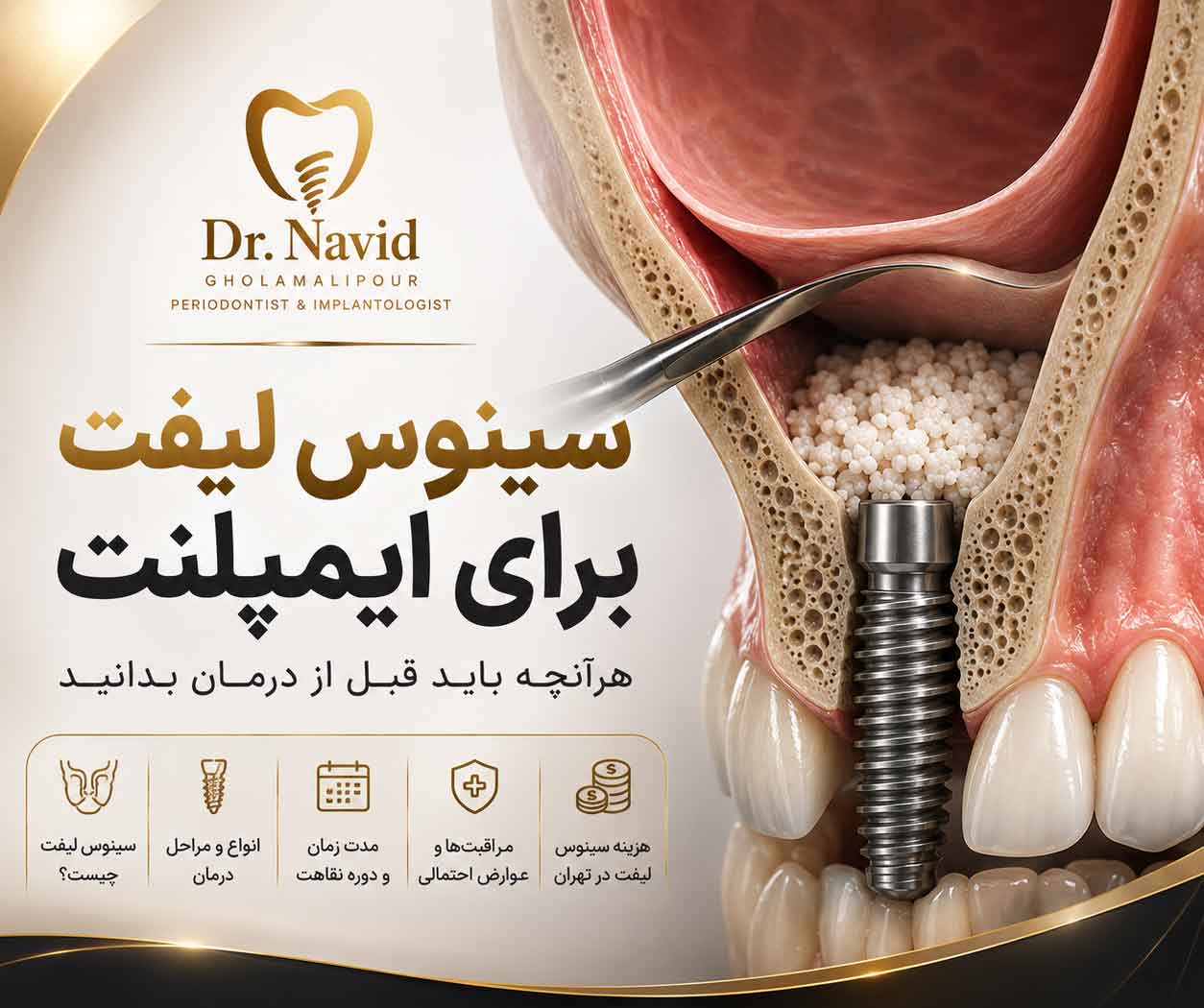 سینوس لیفت برای ایمپلنت