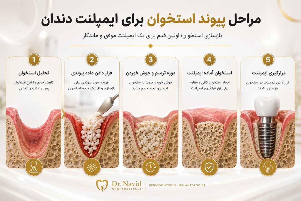 مراحل پیوند استخوان برای ایمپلنت دندان