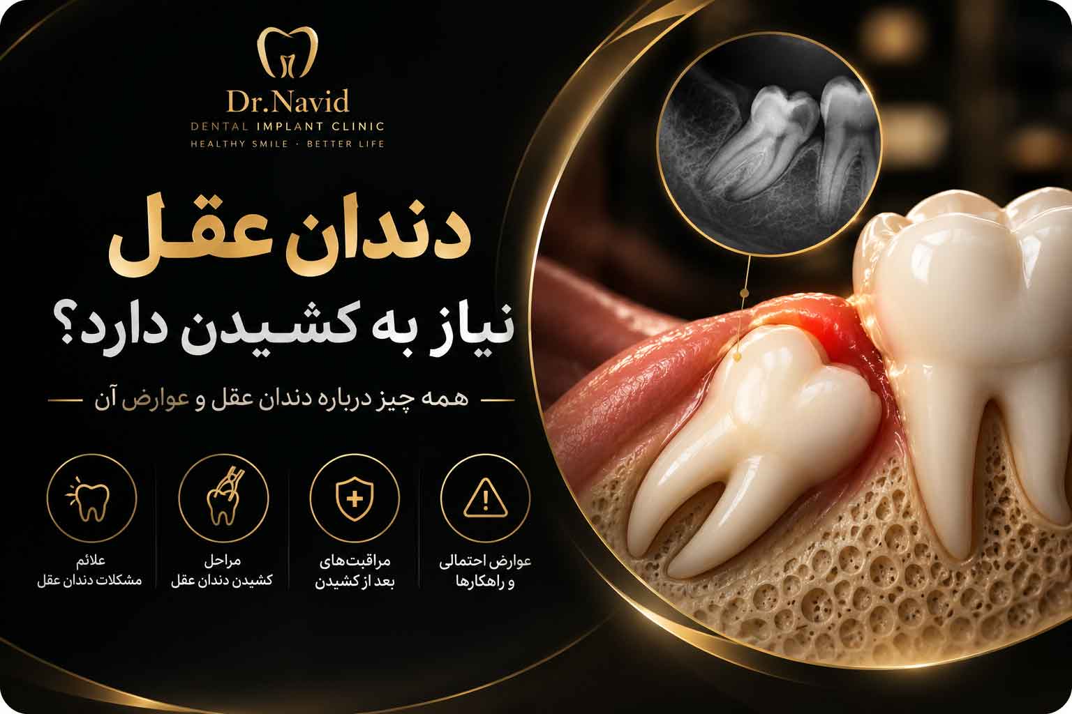 دندان عقل